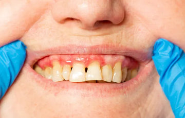 The Best Toothpaste for Periodontal Disease: What to Look For and Why It Matters