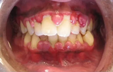 I Healed My Receding Gums