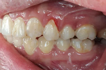 Bleeding gums when brushing