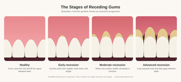 Illustration of the stages of receding gums from healthy to advanced recession